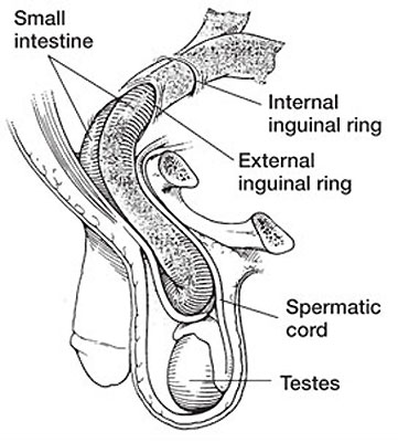 File:Male - inguinal hernia.jpg