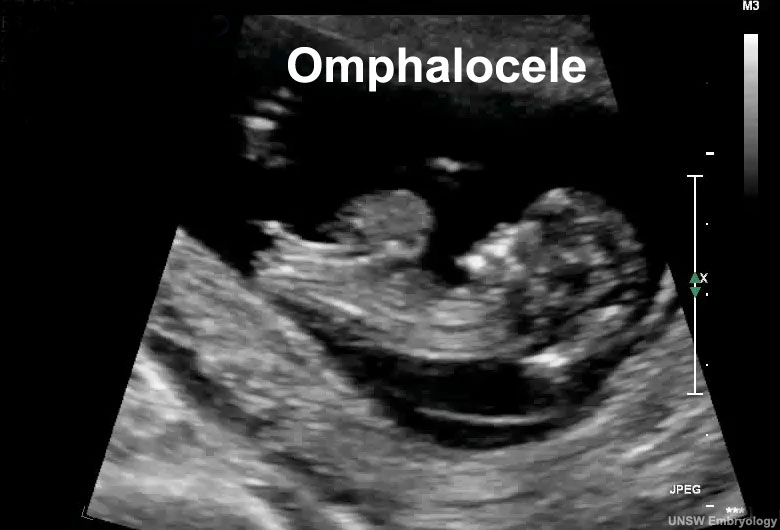 File:Omphalocele 01 icon.jpg