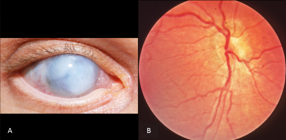 File:LCA fundus and cataracts.jpg