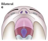 File:Type Bilateral cleft palate.jpg