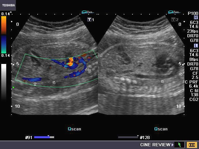 File:ZDoppler Image of Fetal Aorta.jpg