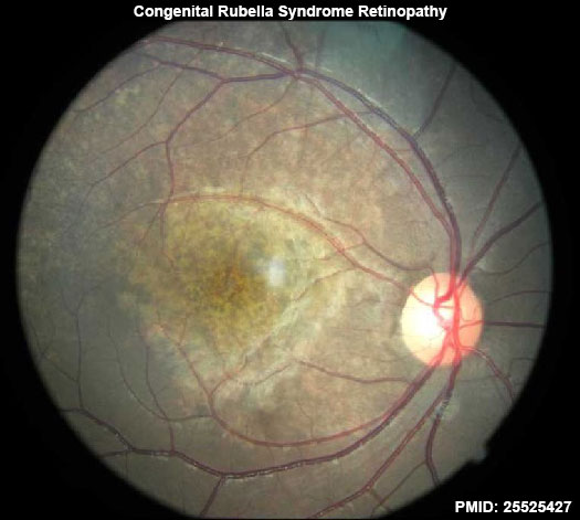 File:Congenital rubella syndrome retinopathy 01.jpg