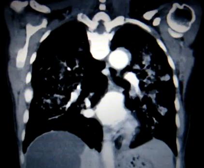 File:CT lungcancer.JPG