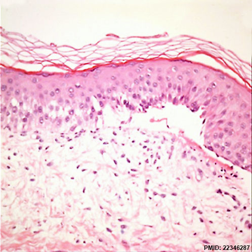 File:Epidermolysis bullosa simplex 01.jpg