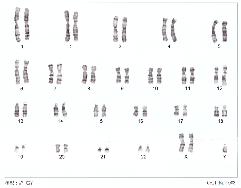 File:Karyotype of Klinefelter's Syndrome.png