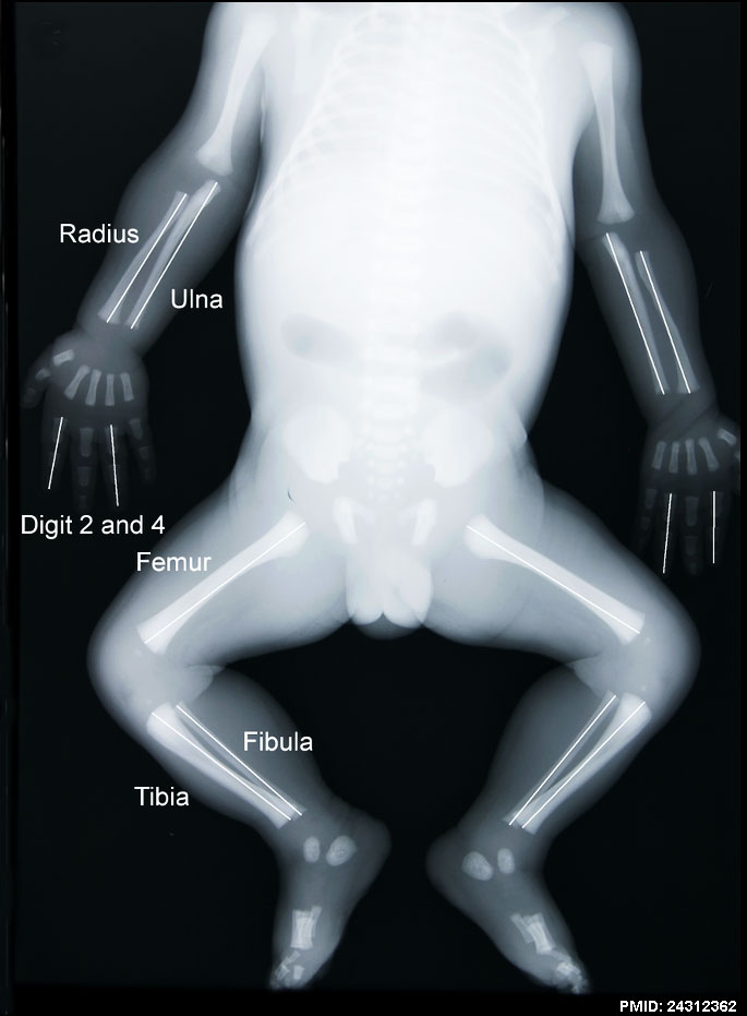 Fetal limb X-ray