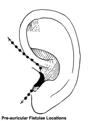 File:Pre-auricular fistulae locations.jpg
