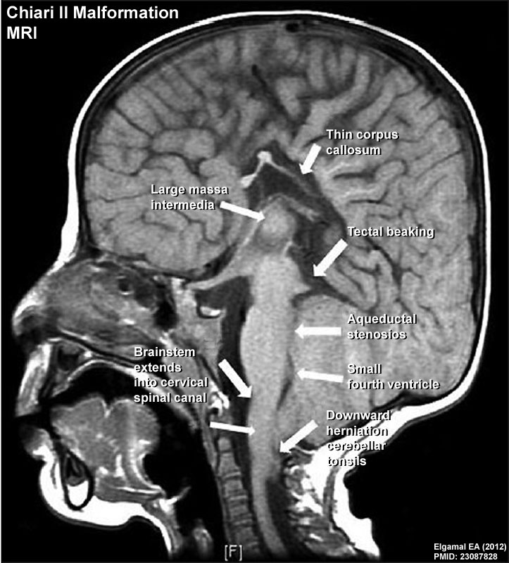 Chiari II malformation MRI02.jpg