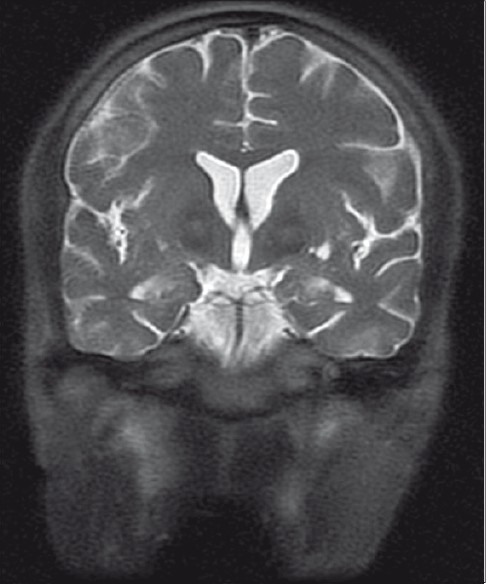 File:Neuroacanthocytosis.jpg