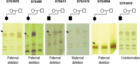 File:Genotyping of the five microsatellites markers in WBS families.jpg
