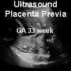 File:US Placenta Previa GA33week icon.jpg
