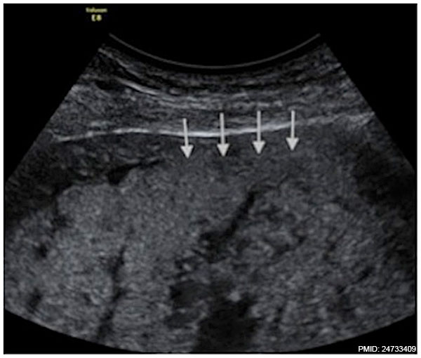File:Placenta accreta ultrasound retroplacental clear space loss.jpg