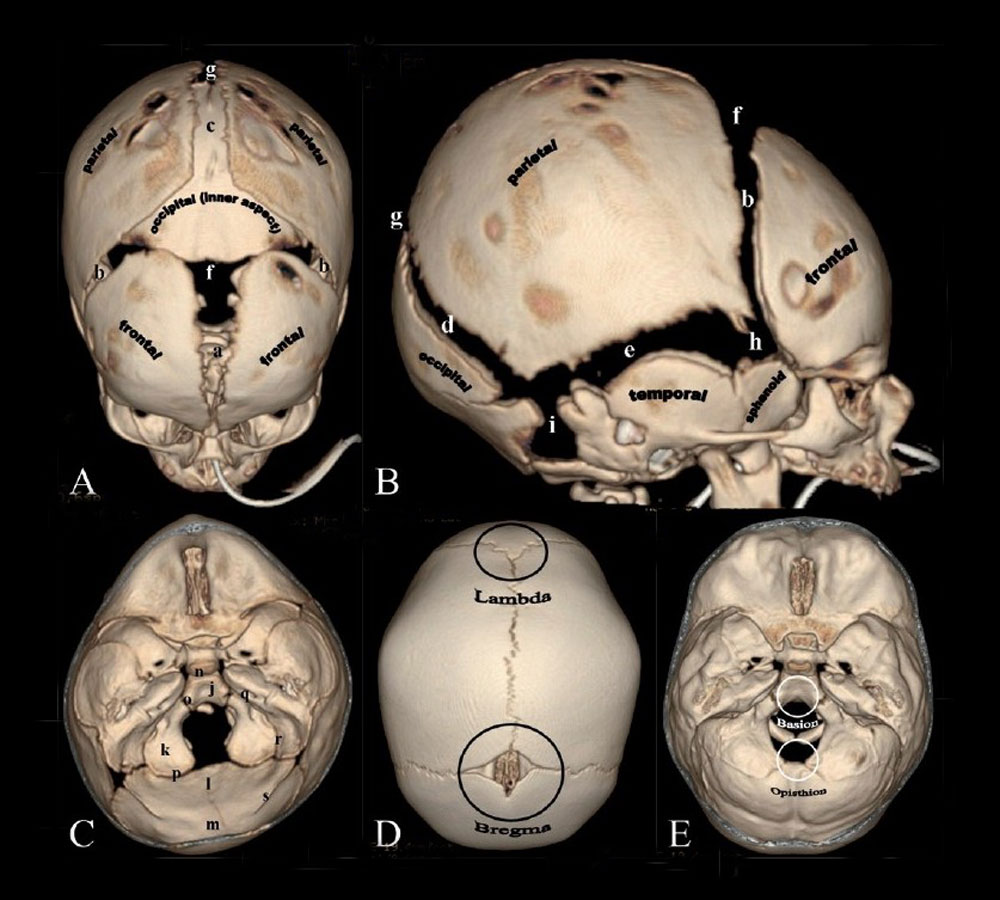 Skull CT normal sutures.jpg