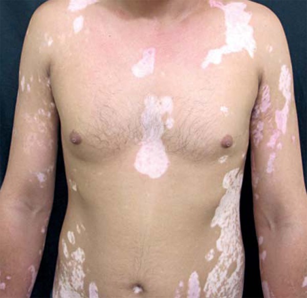 File:Common Vitiligo.jpg