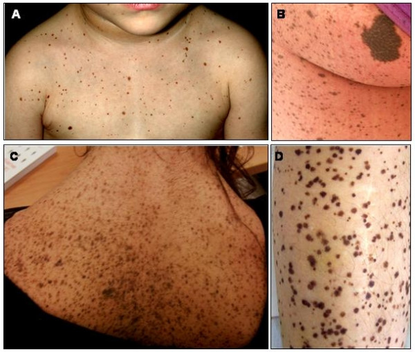 File:Leopard syndrome skin appearance.jpeg