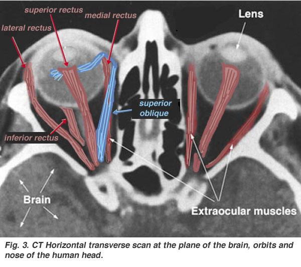 File:Extraocular-muscles-scan.jpg