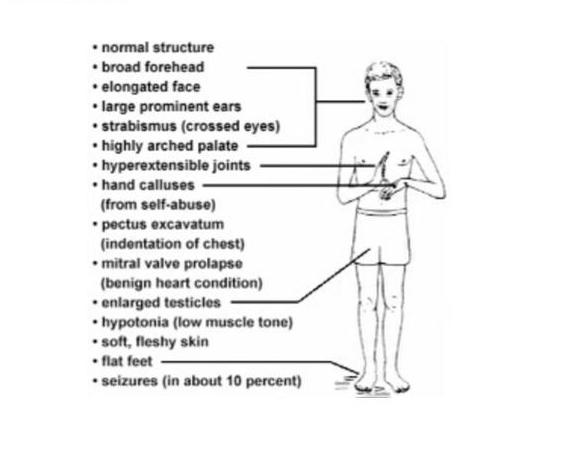 File:Symptoms of Fragile X Syndrome.JPG