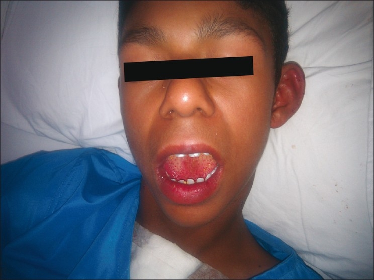File:Characteristic facial features of a child with Willams Syndrome.jpg