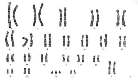 Trisomy 21 female