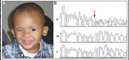 File:Unilateral microphthalmia patient with delection of SOX2 gene.png