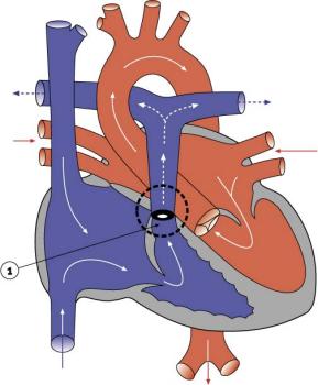 Pulmonary Stenosis.jpg