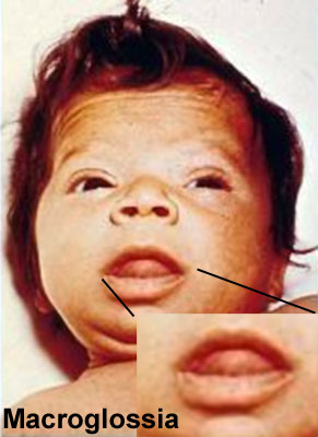 File:Congenital hypothyroidism macroglossia.jpg