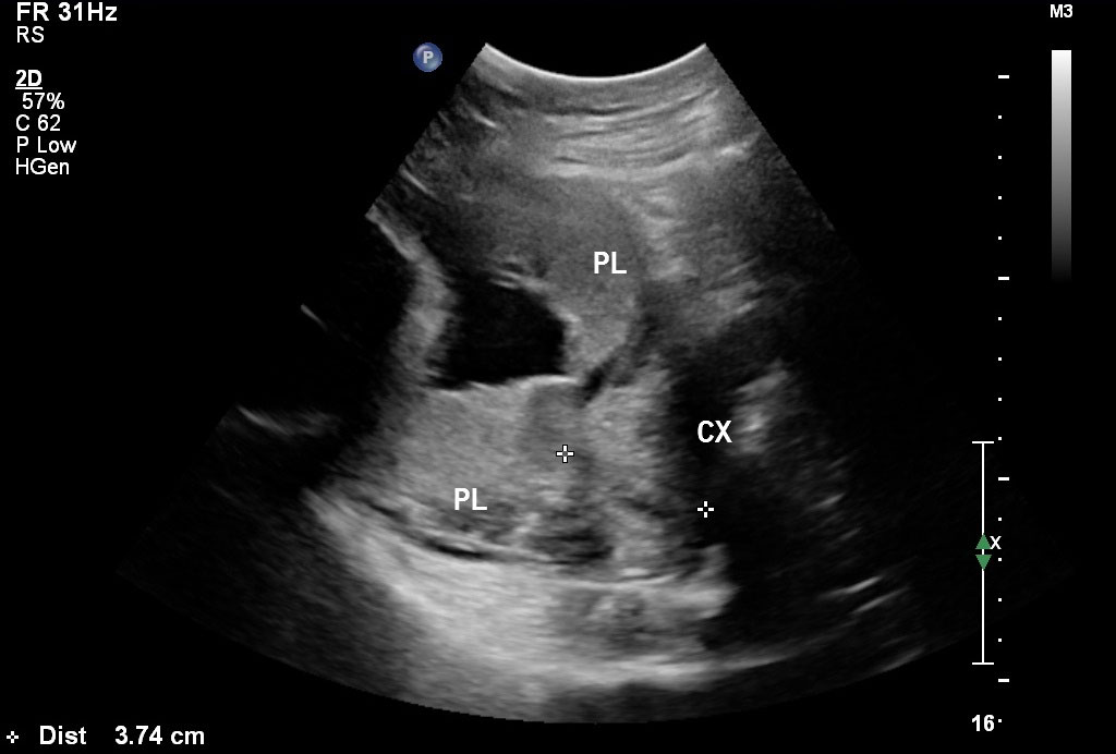 Placenta Abnormalities Ultrasound