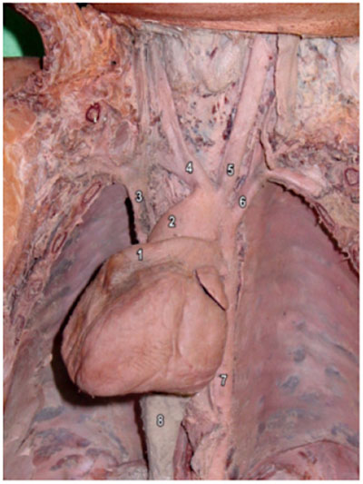 File:Dextrocardia heart position.jpg