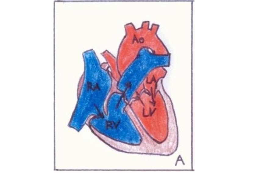 Drawing Of A Normal Heart.PNG