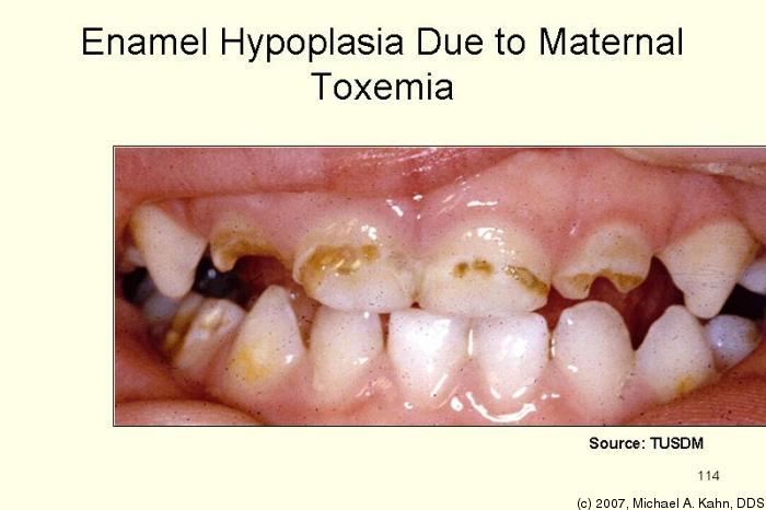 File:Enamel Hypoplasia Due to Maternal Toxemia.jpg