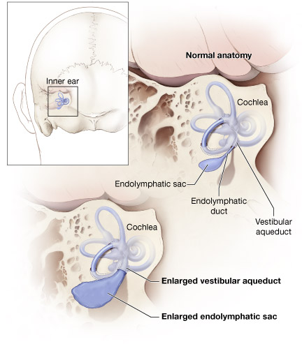 File:Hearing-vestibular sac abnormality.jpg