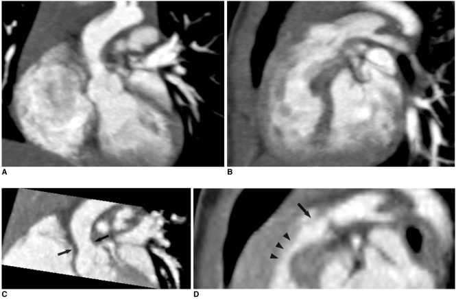 File:Scans of Supravalvular Aortic Stenosis and Pulmonary Stenosis.jpg