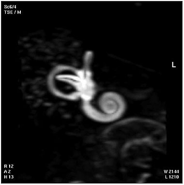 File:Cochlea MRI 01.jpg