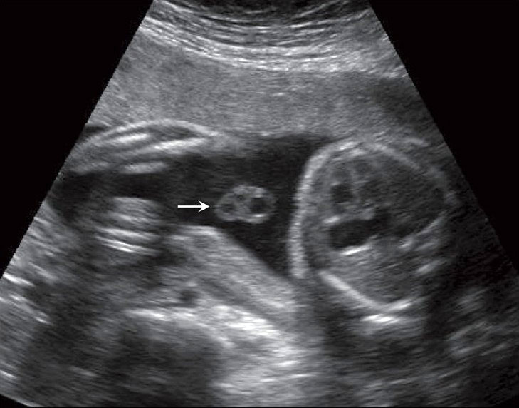 File:Placental cord ultrasound 04.jpg