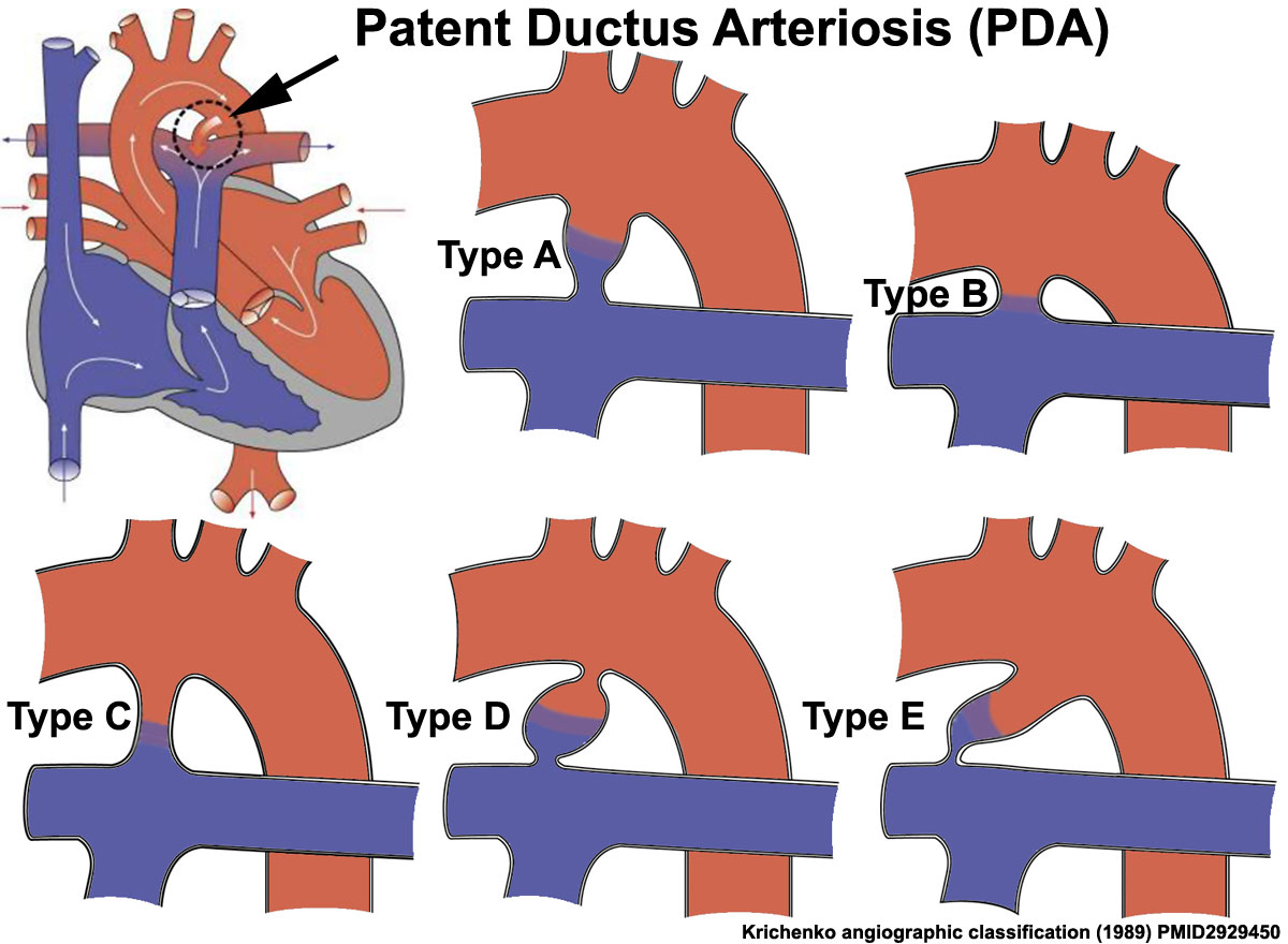 Patent ductus arteriosus classification.jpg