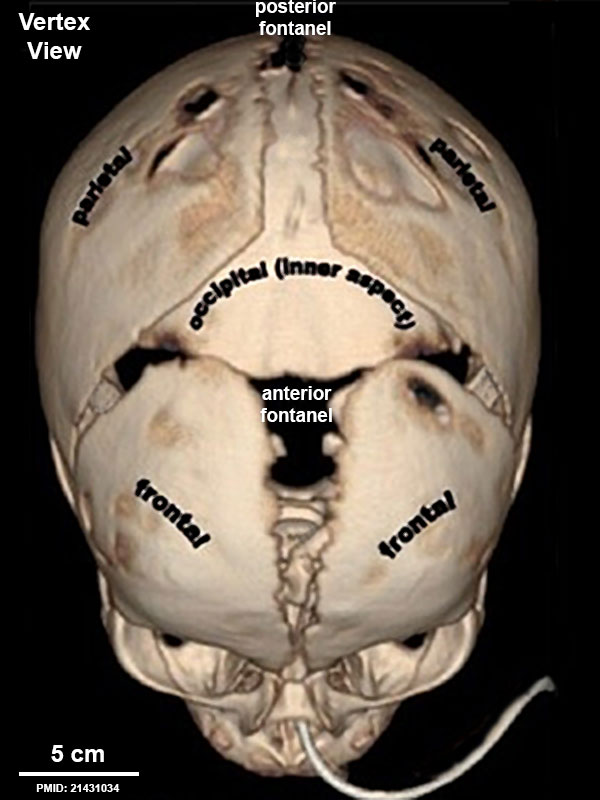 Skull CT normal sutures 03.jpg