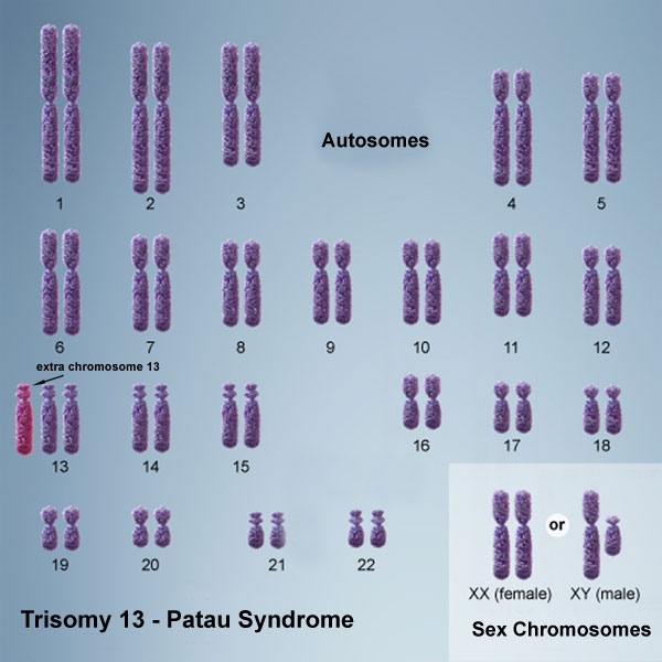 File:Chromosome- trisomy 13.jpg