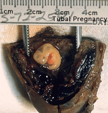 Tubal pregnancy.gif