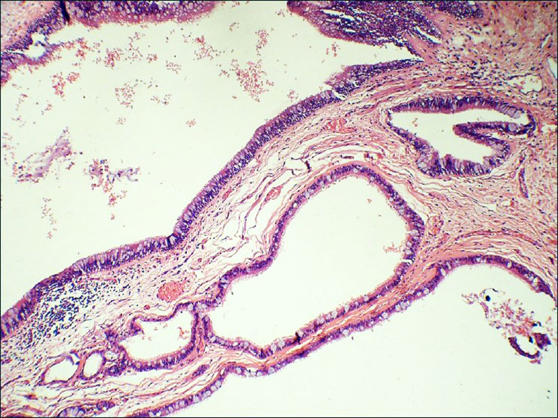 File:Germ cell tumor 02.jpg