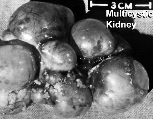 File:Multicystic kidney.jpg