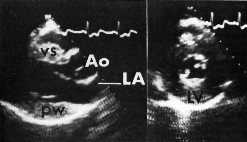 File:Echocardiogram concentric left ventricular hypertrophy.jpg