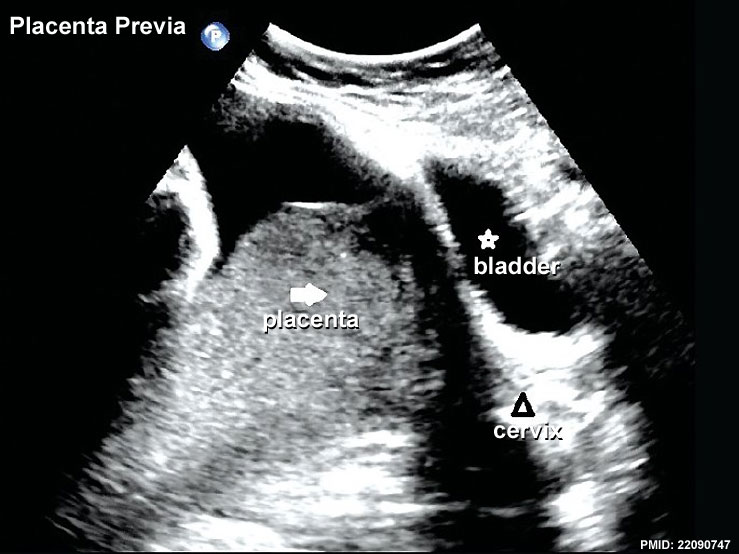 File:Placenta previa ultrasound 01.jpg