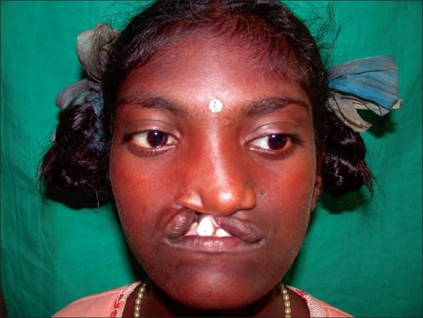File:Median facial dysplasia.jpg