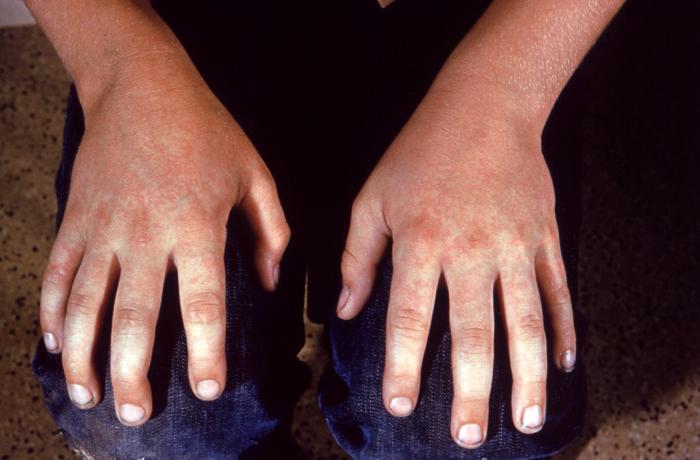 File:Parvovirus infection childhood hands.jpg