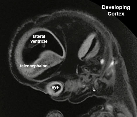 File:Stage23 MRI S01-cortex.jpg