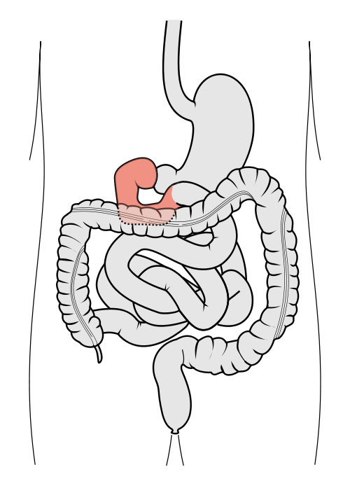 File:Duodenum cartoon.jpg - Embryology