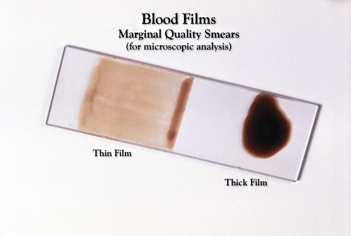 File:Blood Smear Slide 02.jpg