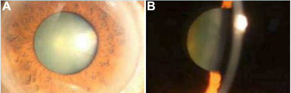 File:Images of congenital hereditary cataracts due to mutations of crystallin genes.png