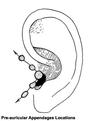 File:Pre-auricular appendages locations.jpg