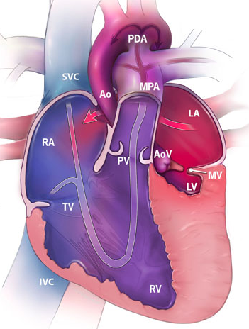 File:Hypoplastic Left Heart Syndrome (HLHS).png